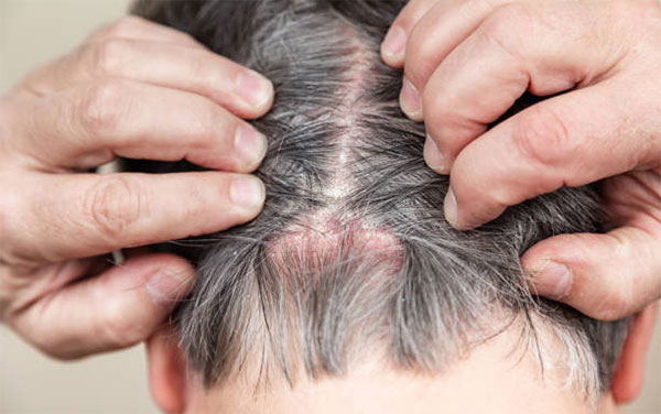 Bệnh vảy nến da đầu do nguyên nhân rối loạn hệ miễn dịch